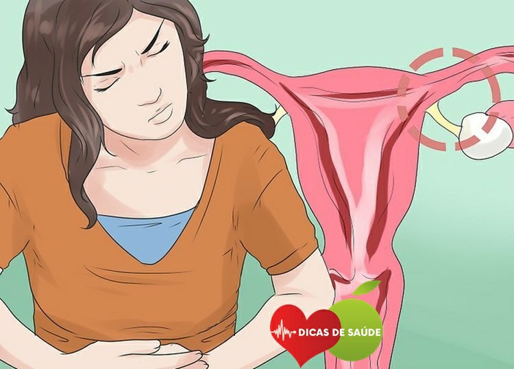 Estágio da Endometriose