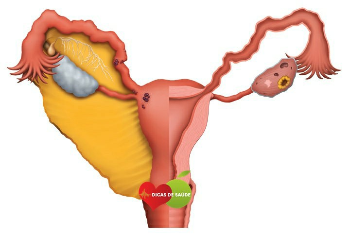 Estágio da Endometriose