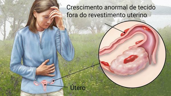 Endometriose