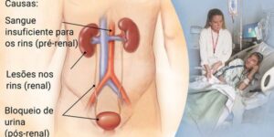 insuficiência renal aguda