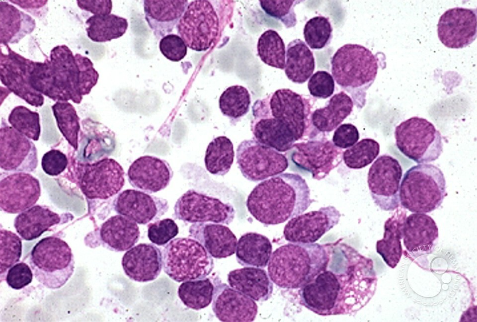 leucemia linfocítica aguda 3