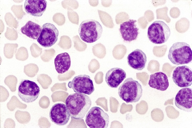 leucemia linfocítica aguda
