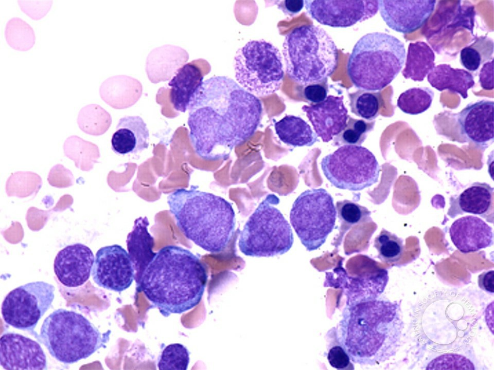 leucemia mieloide aguda 1
