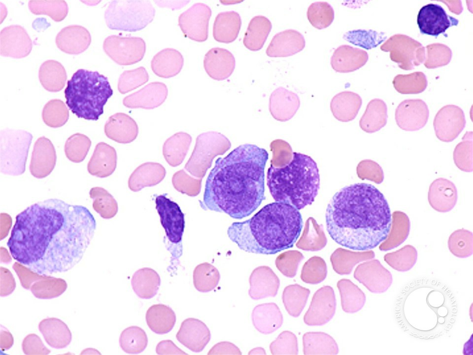 leucemia mieloide aguda