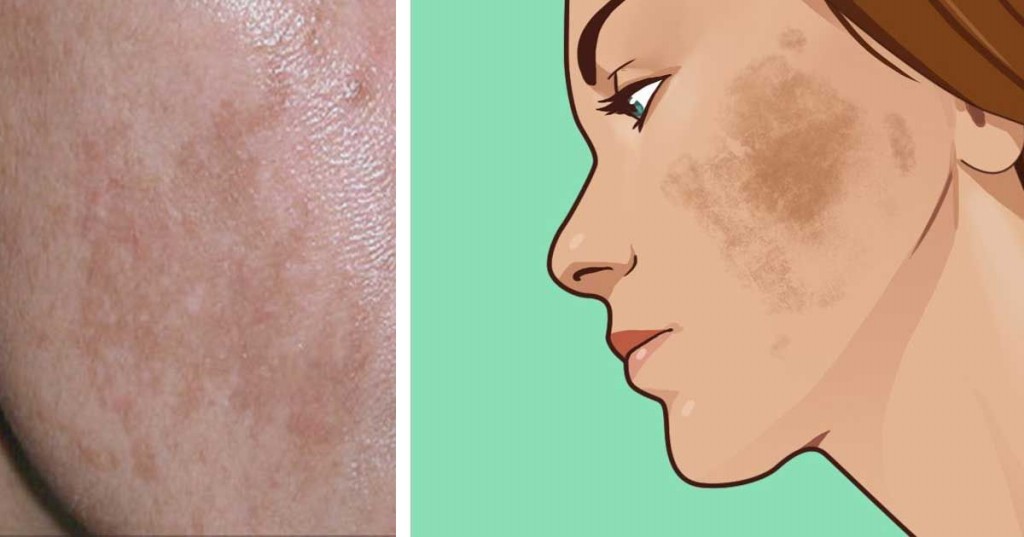 melasma