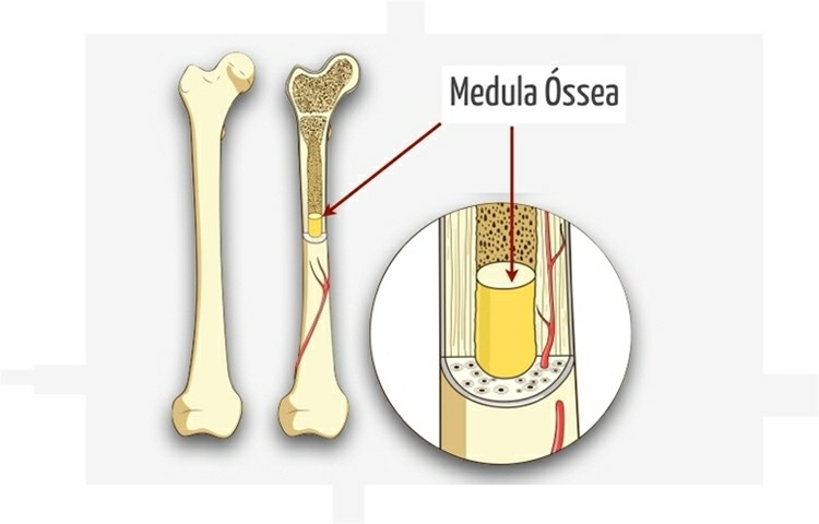 mielofibrose 1