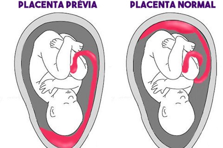 Placenta Prévia