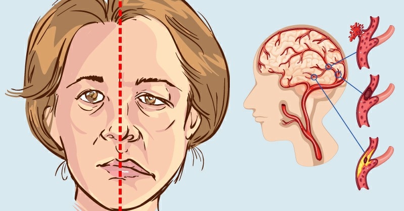 Acidente vascular cerebral