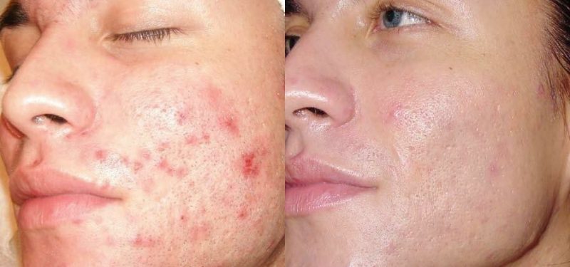 Suco Detox de Couve e Abacaxi Para Diminuir as Espinhas