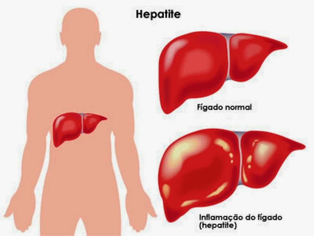 hepatite resumo
