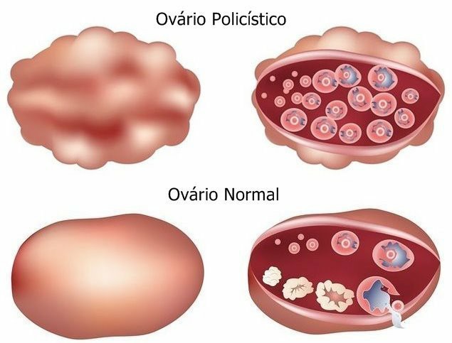 remedios caseiros para sindrome do ovario