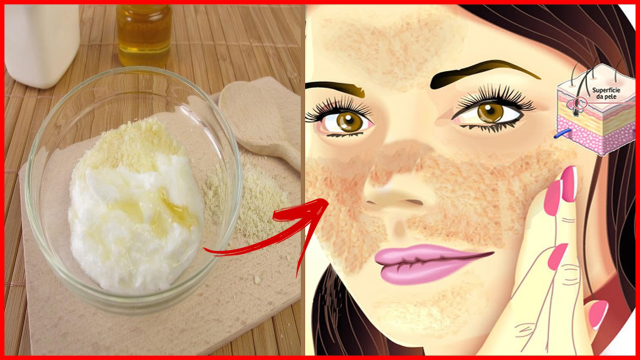 ACABE de vez com o Melasma no Rosto Usando esta receita em 7 dias