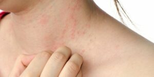 alergia-dermatologica