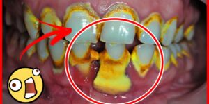 Como REMOVER o Tártaro dos Dentes em 5 Minutos SEM Ir ao Dentista