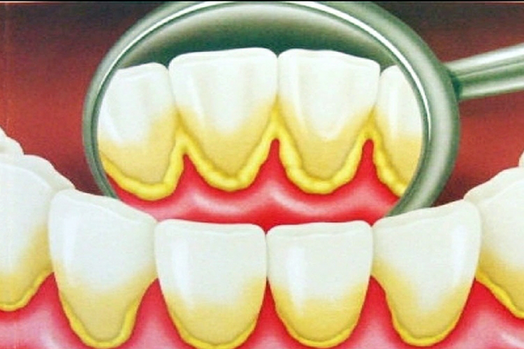 Como REMOVER o Tártaro dos Dentes em 5 Minutos SEM Ir ao Dentista!
