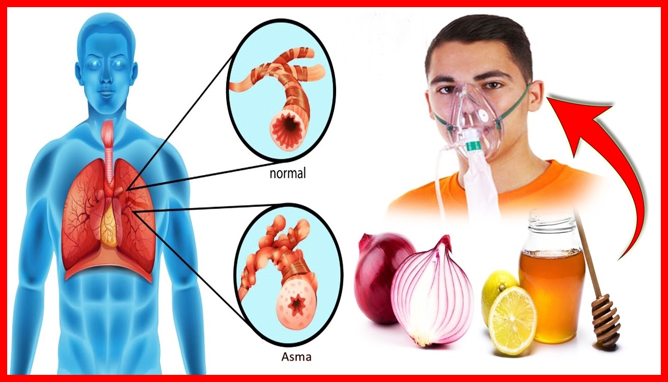 Cura Natural Asma Como Tratar e Evitar que a Doença Respiratória se Agrave com 2 Receitas