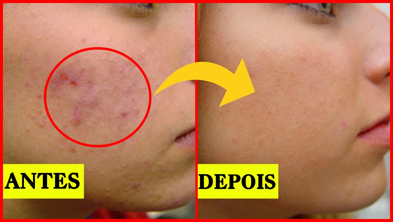 Cura Natural CICATRIZES DE ACNE Como se Livrar das Cicatrizes Causadas Pela Acne em 2 SEMANAS