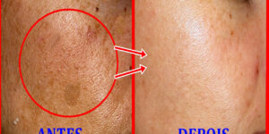 elimine o melasma