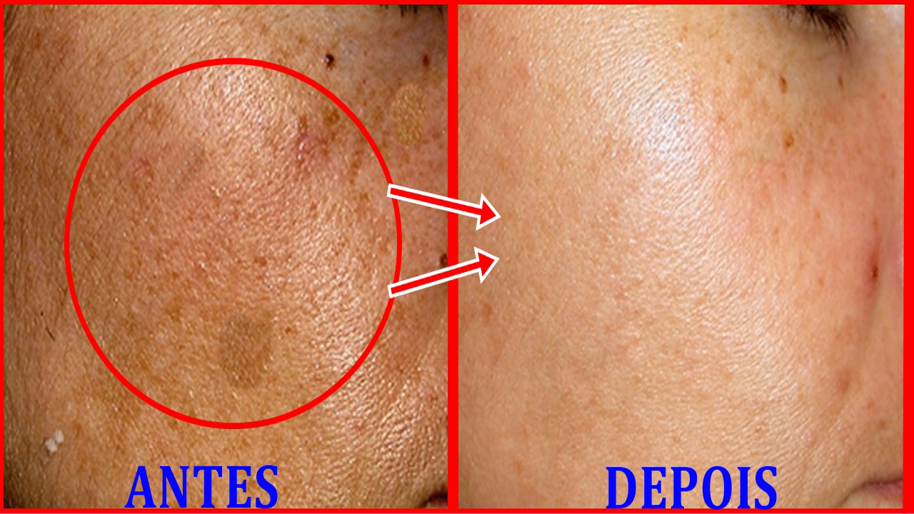 elimine o melasma