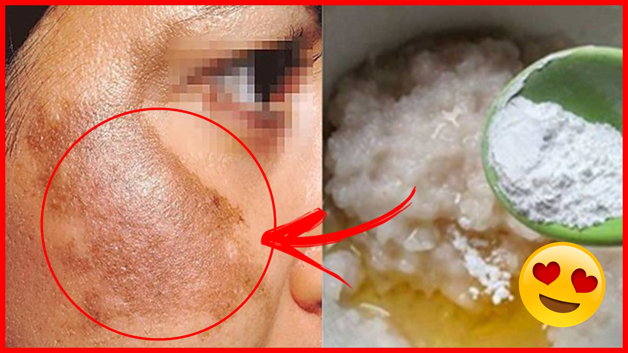 Esta RECEITA ELIMINA o Melasma e Clareia a Pele em 7 Dias