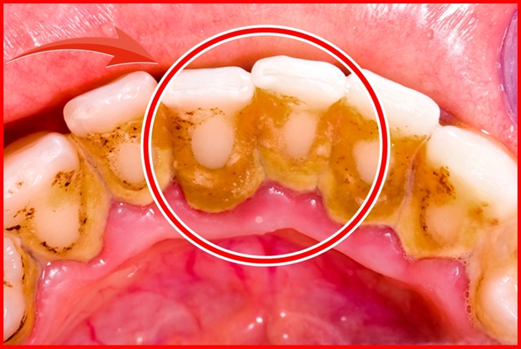 Truques para Remover a Placa bacteriana em 5 minutos