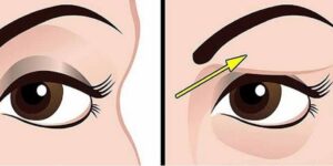 dicas-caseiras-para-acabar-com-olhos-inchados