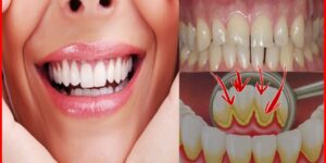 Como Eliminar a Placa Bacteriana dos Dentes