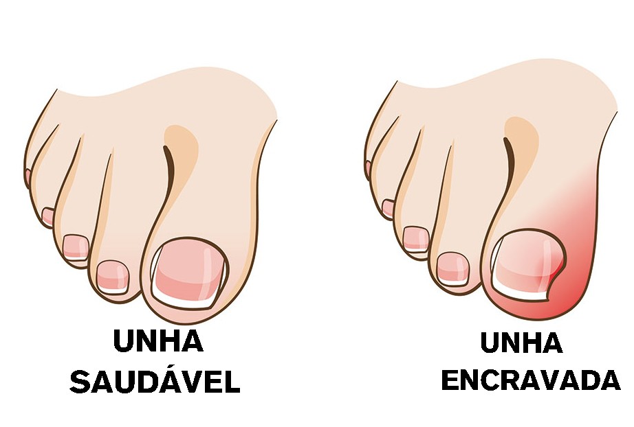 unhas encravadas