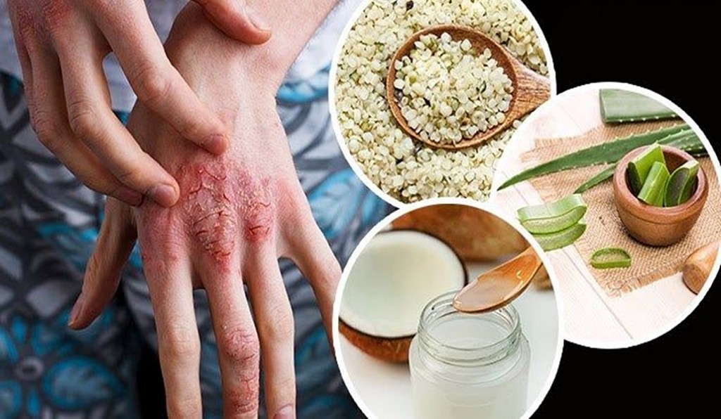 Tratar Eczema Tratar Eczema