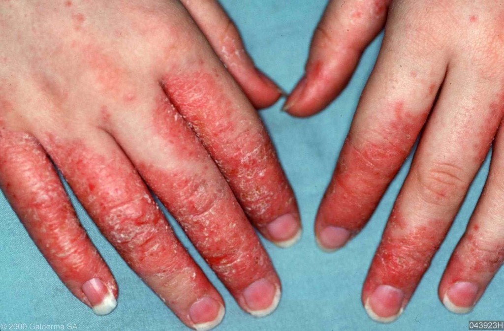Remédios Caseiros Para Tratar Eczema