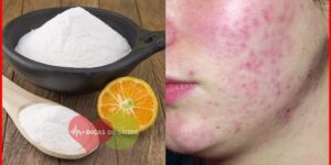 bicarbonato de sódio para tratar a acne