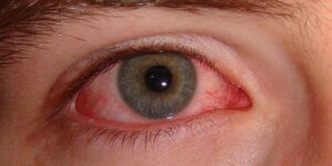 remedios caseiros para sindrome dos Olhos Secos