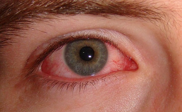remedios naturais para sindrome dos olhos secos