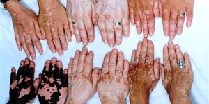 vitiligo