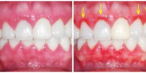 remedios caseiros para tratar gengivas inflamadas