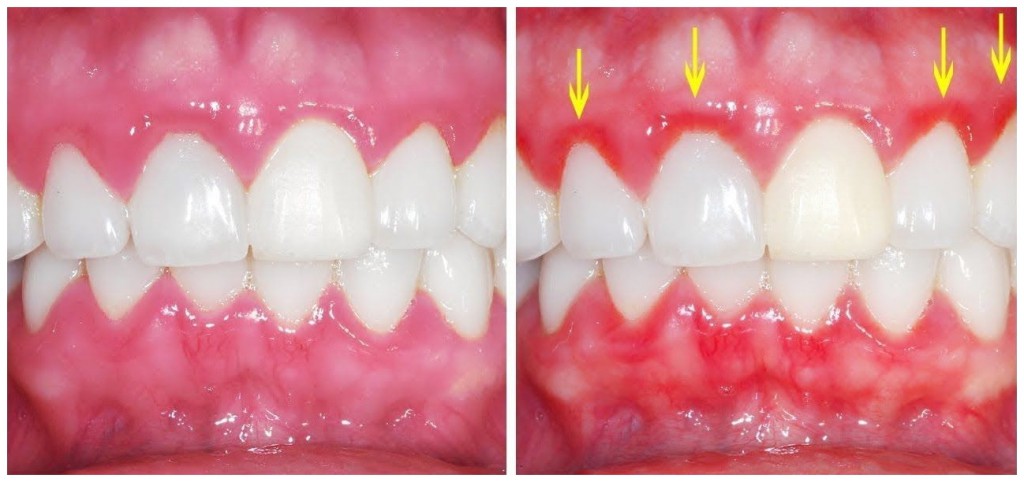remedios caseiros para tratar gengivas inflamadas