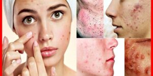 receitas caseiras para combater acne