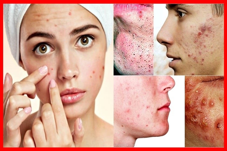receitas caseiras para combater acne