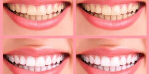 receitas caseira para clarear os dentes