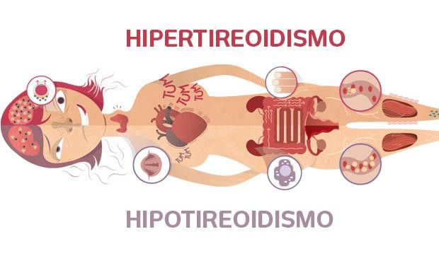 Como Tratar o Hipo e Hipertireoidismo