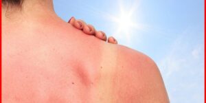 queimaduras na pele causadas pelo sol