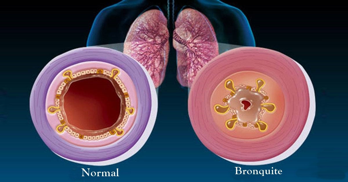 Remédios Caseiros Para Tratar Bronquite