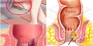 sintomas do cancer no anus