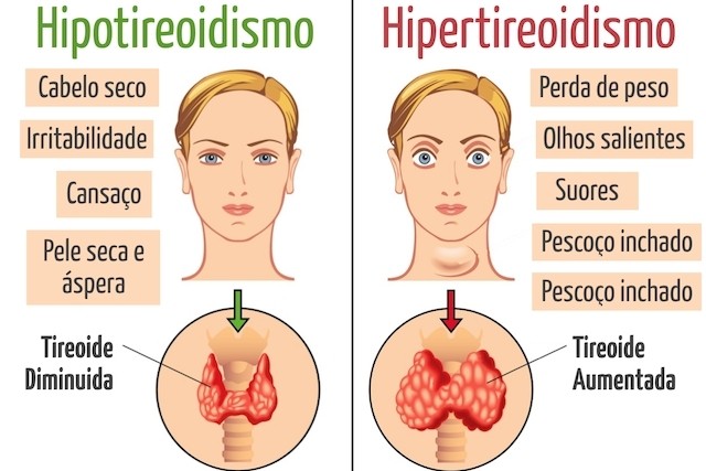 tratar o hipo e hipertireoidismo sem ajuda medica