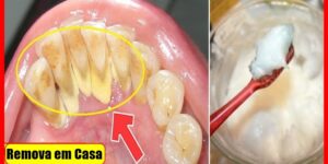 como eliminar o tartaro e clarear os dentes