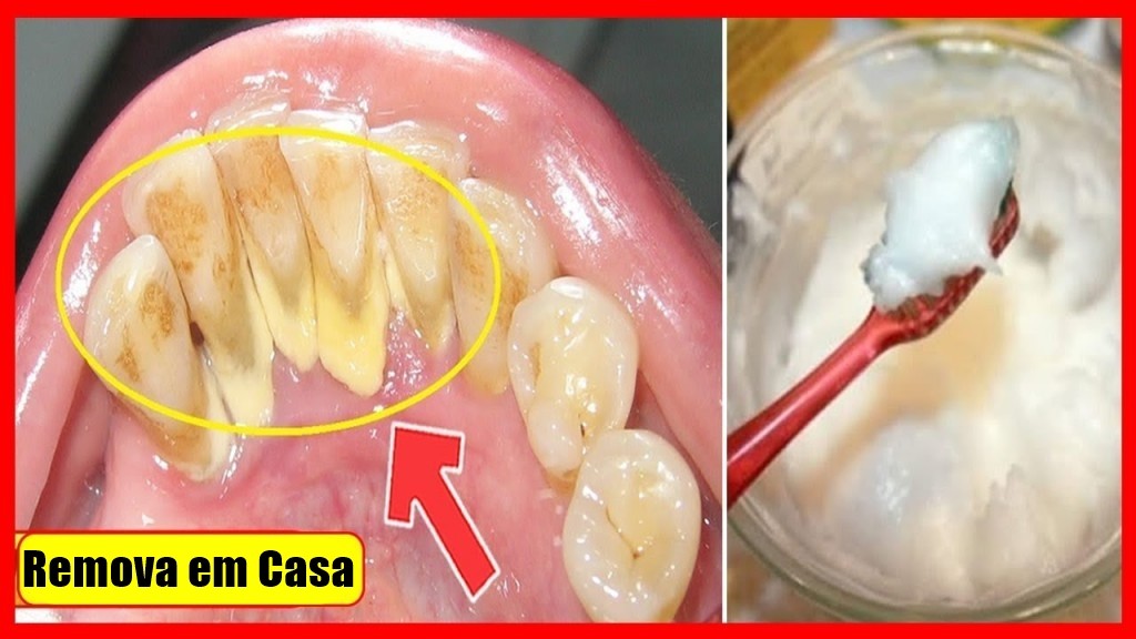 como eliminar o tartaro e clarear os dentes