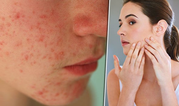As 16 Receitas Para Eliminar as Manchas de Acne