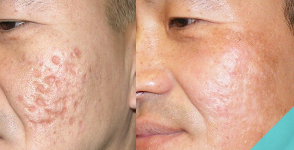 manchas de acne