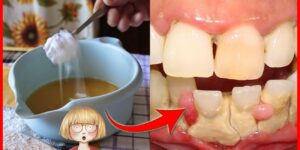 tratamento para remover o tartaro e clarear os dentes