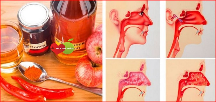 remédios caseiros com vinagre de maçã